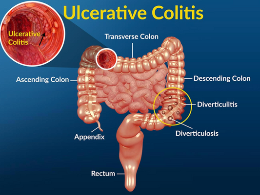 Vitamin D deficiency is associated with so many health problems including  Crohn’s Disease!