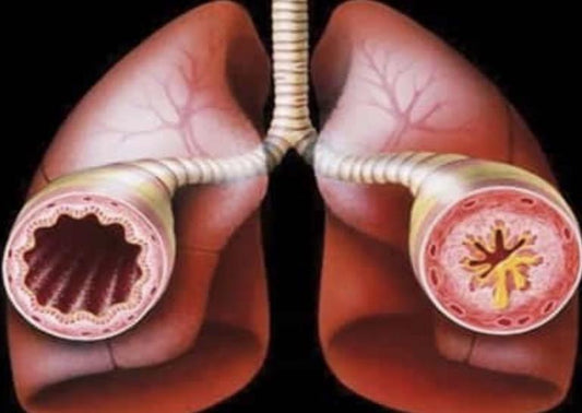 Natural Home Remedies for Asthma