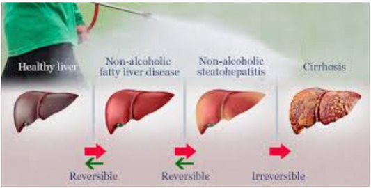 Fatty Liver / Best Herbs for Liver Health!