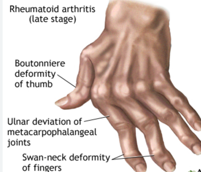 Rheumatoid Arthritis 🧐